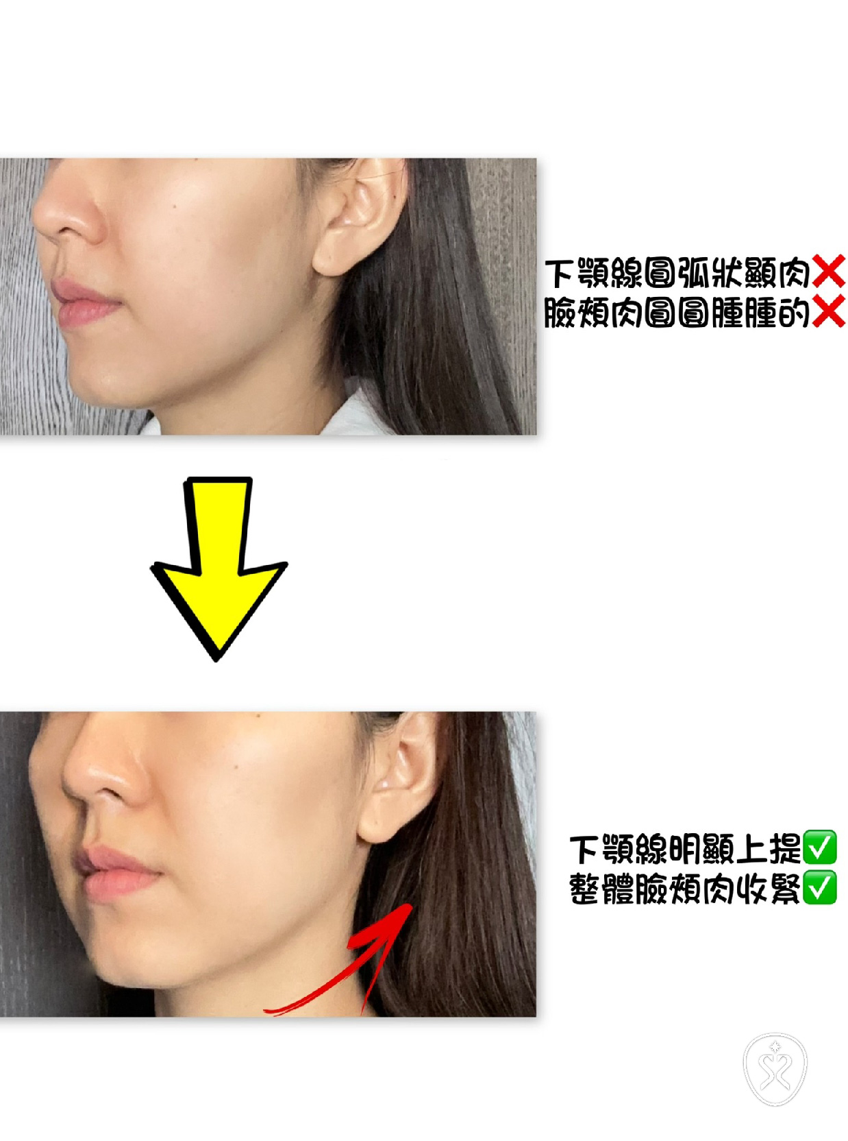 透過十蓓電波下顎線條更加明顯，輪廓更顯立體
